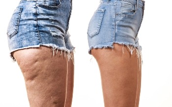 Cellulite entsteht durch eine Übersäuerung des Körpers Quelle: shutterstock