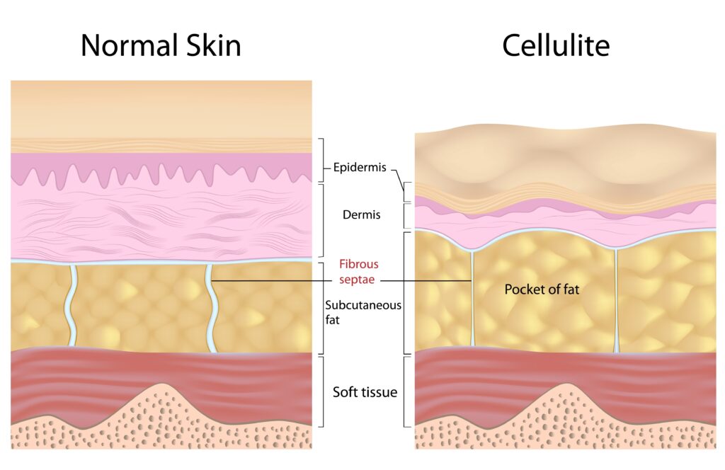 Normale Hautstruktur gegenüber Cellulite